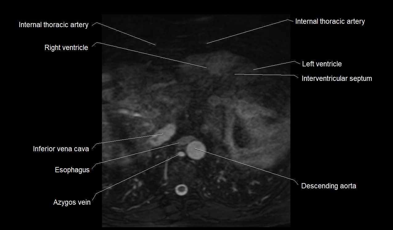 MRI heart coronary arteries and coronary veins anatomy axial image 42.jpg
